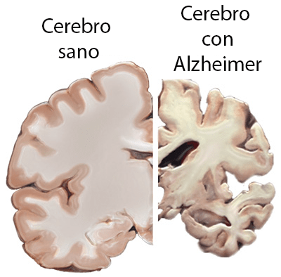 cerebro alzheimer