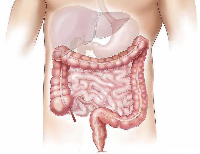 Cómo tratar el síndrome del intestino permeable 